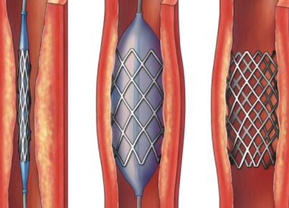 好消息！700元冠脈支架來(lái)了帶量采購(gòu)結(jié)果在甘肅省正式落地執(zhí)行